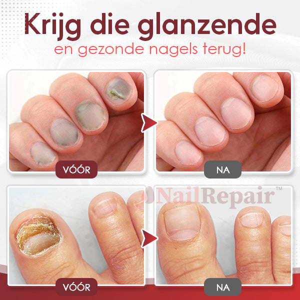 NailRepair™ Antischimmel Nageloplossing