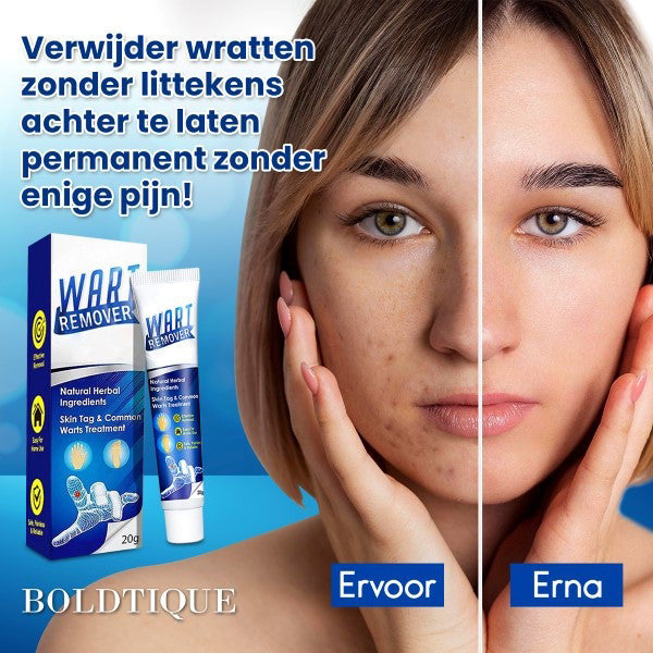 Boldtique™ Crème Tegen Wratten